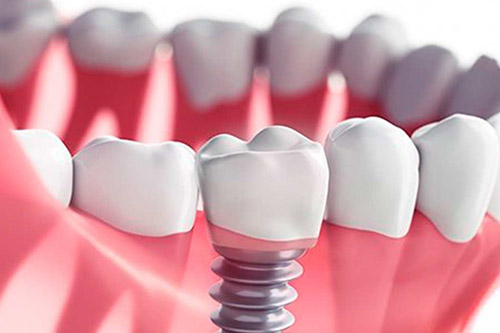 Implantes Dentales: qué son, cómo se colocan, cuánto duran y más